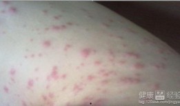 皮肤过敏吃茭瓜行吗,皮肤过敏患者的饮食新选择？