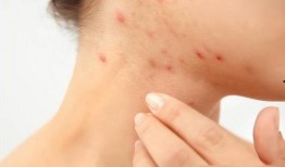 皮肤过敏吃茭瓜行吗,皮肤过敏患者的饮食新选择？